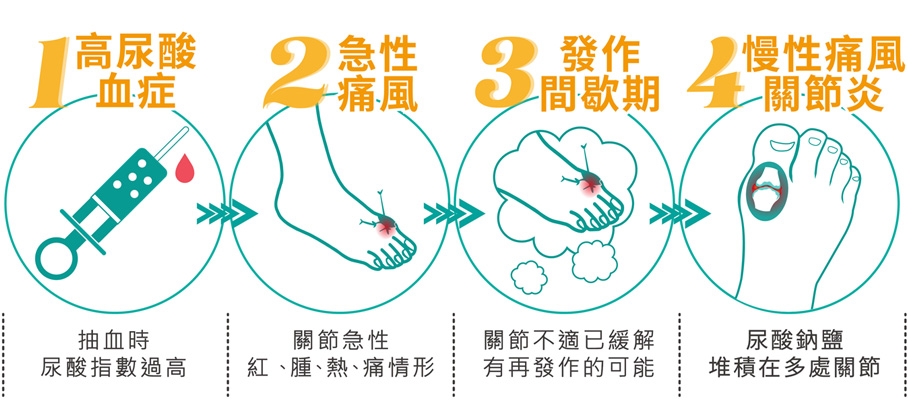 痛風四階段